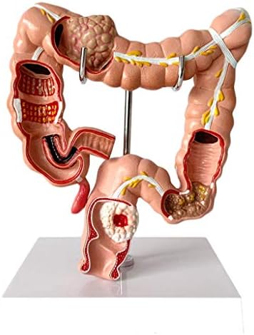 RRGJ Oktatási Modell, az Emberi Vastagbél Anatómiai Modell Zsigeri Elváltozás Modell - Vastagbél Patológia Modell PVC